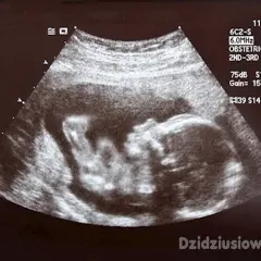 USG połówkowe pokazuje rozwijające się dziecko w łonie matki, z widoczną główką i ciałem.