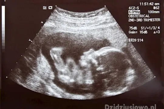 USG połówkowe pokazuje rozwijające się dziecko w łonie matki, z widoczną główką i ciałem.