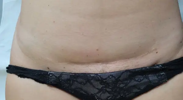 Blizna po cc po roku, widoczna na brzuchu poniżej pępka, lekko zaróżowiona.