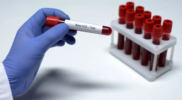 Ręka w niebieskiej rękawiczce trzyma probówkę z napisem "Beta hCG - Test". W tle stojak z innymi próbkami krwi. Czy beta hcg z krwi może się mylić?