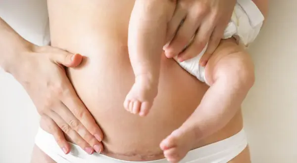 Blizna po cesarskim cięciu na brzuchu mamy, która tuli swoje dziecko. Krocze po porodzie jest w pełni widoczne.